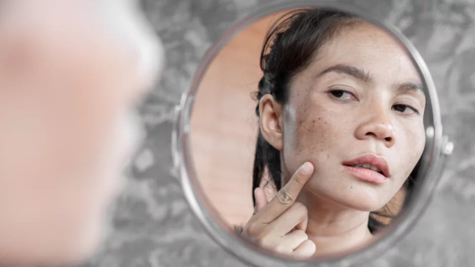 Um rosto de uma mulher com melasma