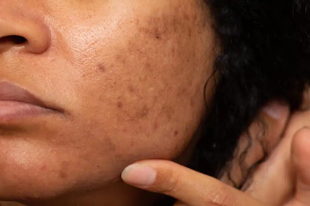 Mulher com rosto com melasma